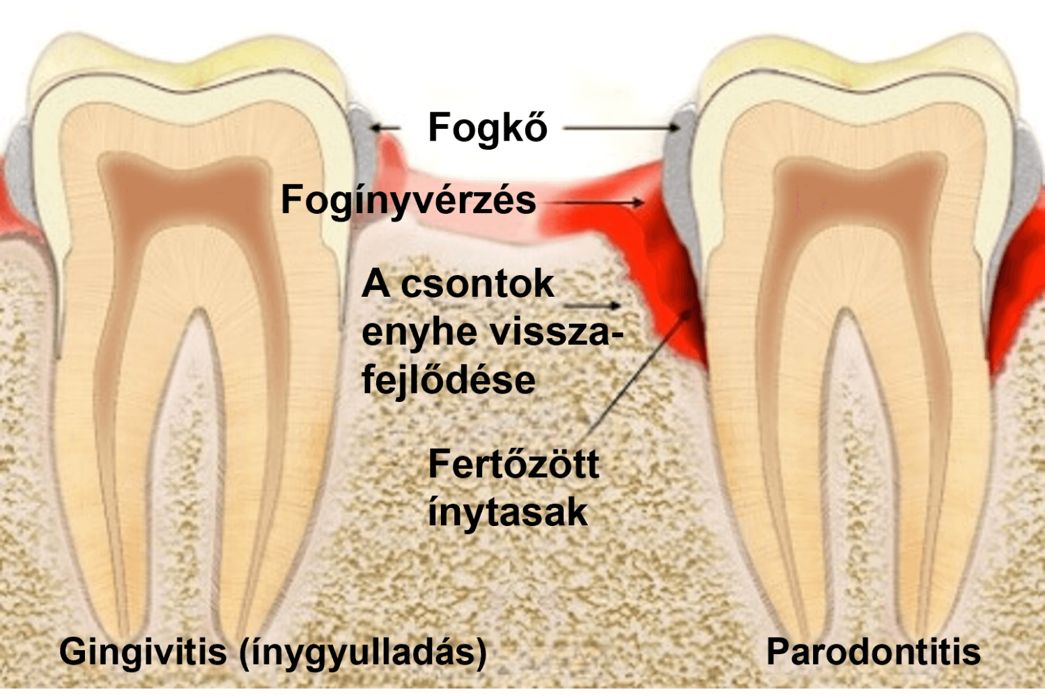 gingivitis (ínygyulladás) és parodontitis összehasonlítása. A parodontózis fogínyvérzéssel, a csontok enyhe visszafejlődésével és fertőzött ínytasakkal járhat.